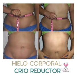 Hielos Reductivos Hieloterapia Kit 5 Hielos + Gel + Loción