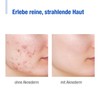 aknederm Cream 30 g - Mattifying Face Cream Against Pimples