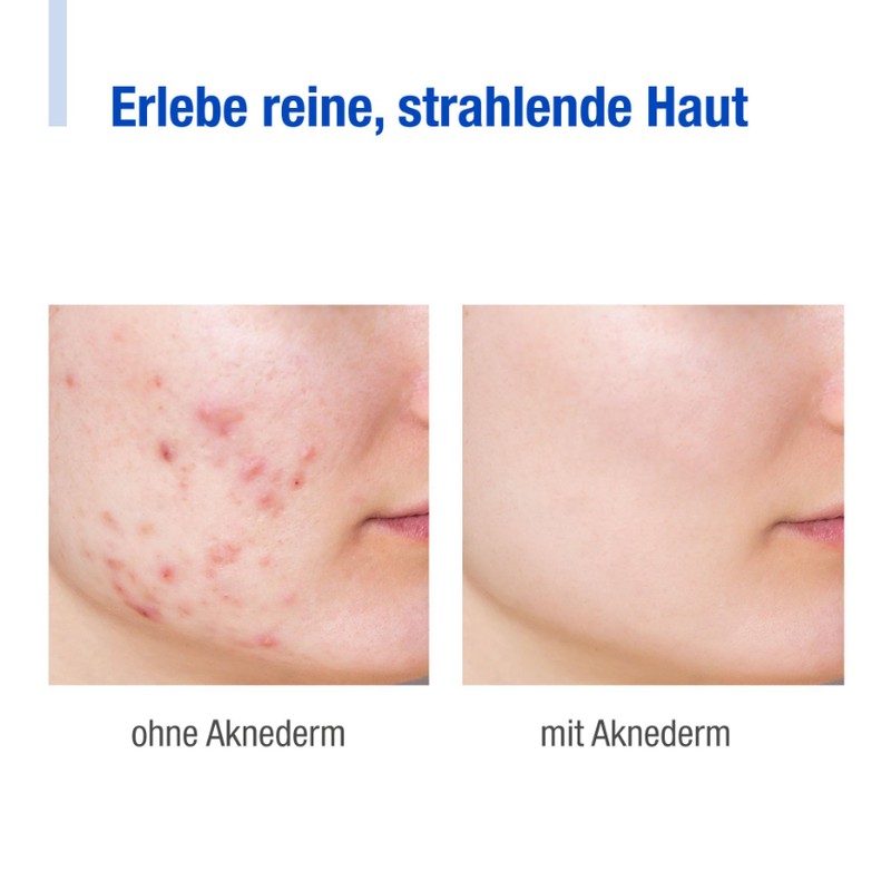aknederm Cream 30 g - Mattifying Face Cream Against Pimples