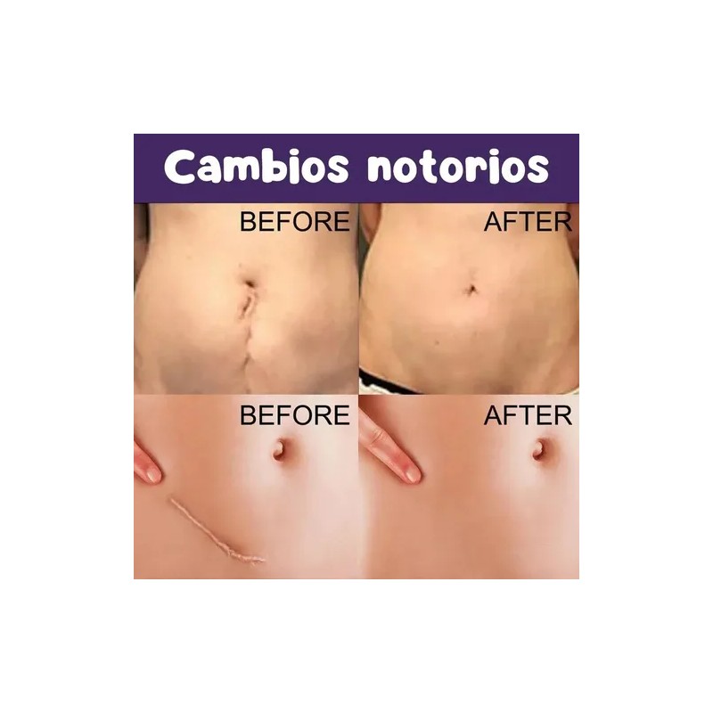 8 Parches Silicona Reutilizables Cicatrices Grado Medico F