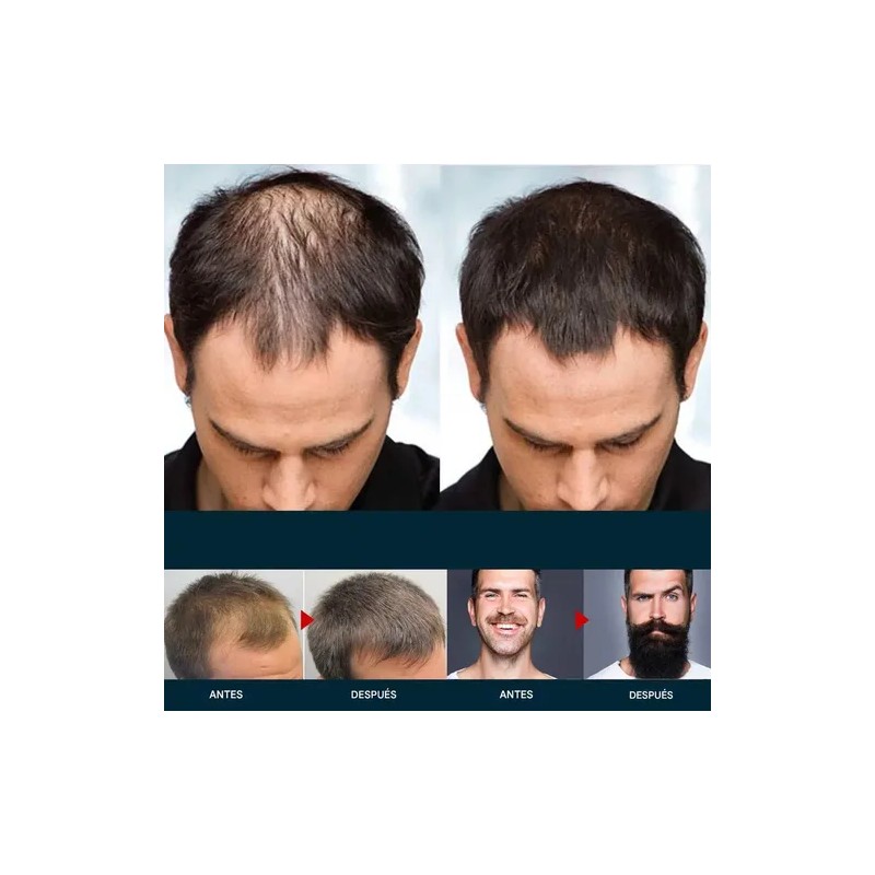 Esencia Anticaída Para El Cuidado Del Cabello Masculino-3pcs