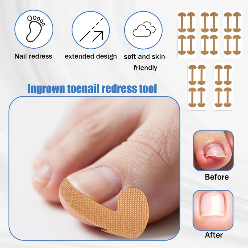 17pcs Ingrown Toenail Corrector Set, Professional Ingrown Toenail Pedicure Tools