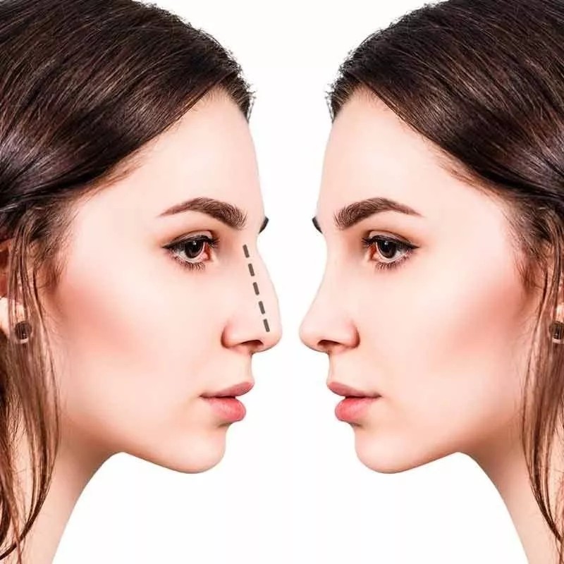 3D Rhinoplasty Respingadores Nasales 7 Pzs Original Levanta Estiliza Nariz
