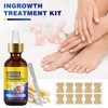 60ML Ingrown Toenail Treatment Set,Ingrown Toenail Softening Drops,Professional Ingrowing Toenail