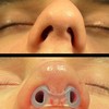 Nostril Retainer Short Model | Nostril Retainer Rhinoplasty | Nasal