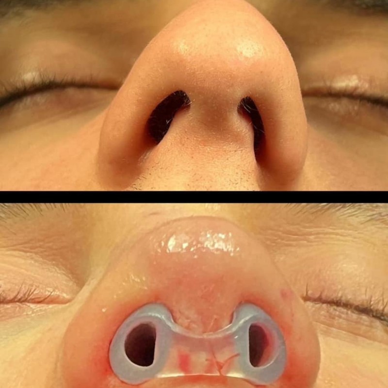Nostril Retainer Short Model | Nostril Retainer Rhinoplasty | Nasal