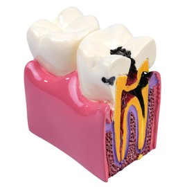 Sarini Tooth Model, Caries Comparative Study Model,Dentist Dental Anatomy Educational Tooth Model, Suitable For Dentists Patients Teachers And Students Dental Research And Study
