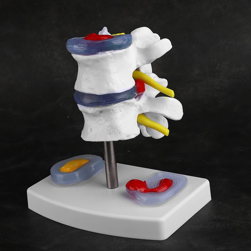 Human Size Medical Model - Anatomical Herniated Disc Demonstration Accessories