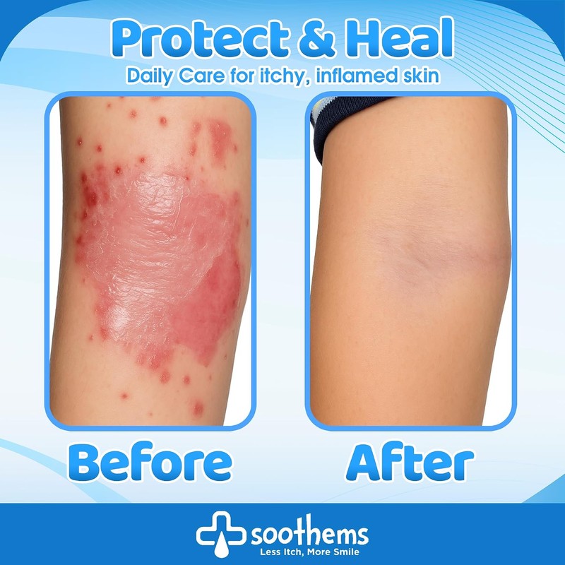 Eczema Psoriasis - Mangas para brazos y rodillas para niños