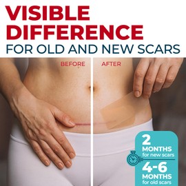 Medical Grade Silicone Scar Sheets - 4pk (5.7”x1.6”) - Visible Difference on Surgical & Keloid Scars - Reusable C-Section Scar Silicone Strips - Easy to Use Silicone Sheets for Scars
