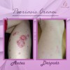 4pack Psoriasis Cream, Facial Corporal Psoriasis Aliviante.