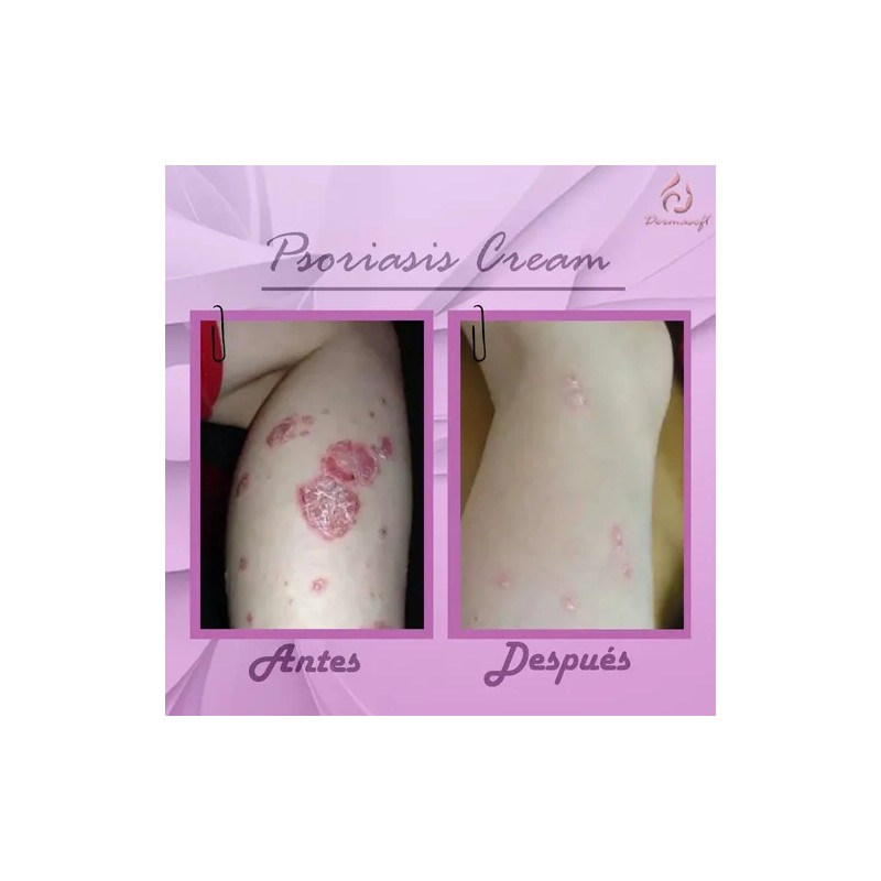 4pack Psoriasis Cream, Facial Corporal Psoriasis Aliviante.
