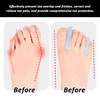 10-Piece Toe Orthotics, Large Toe Separators, Large and Small Toe