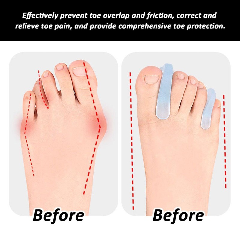 10-Piece Toe Orthotics, Large Toe Separators, Large and Small Toe
