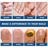 Pack of 42 Nail Patches for Toenails and Fingernails, Multi-Purpose