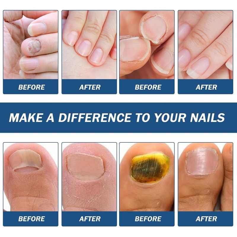 Pack of 42 Nail Patches for Toenails and Fingernails, Multi-Purpose