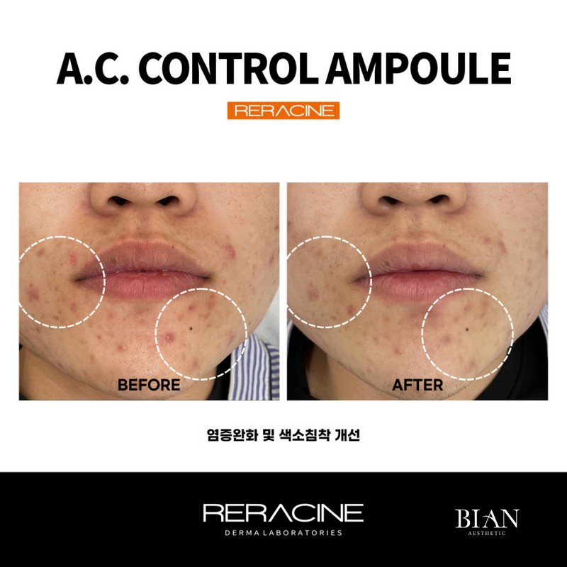 Lyricin Lilacin AC Control Ampoule 30ml / 리라신 AC컨트롤 앰플