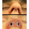 Nostril Retainer (2 Pack – Different Sizes) | Nose Splint