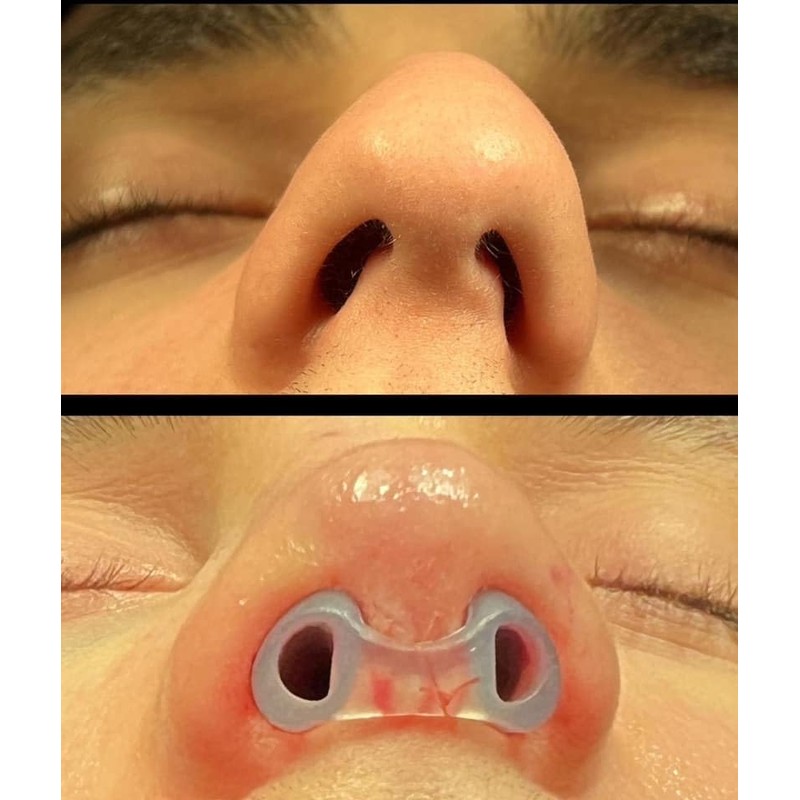 Nostril Retainer (2 Pack – Different Sizes) | Nose Splint