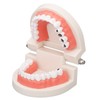 Dental Disease Caries Teeth Model Resin Simulation Teaching Prop Dental