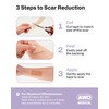 AWD Medical AWD Silicone Scar Sheets for Surgical Scars -
