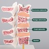 Ultrassist Osteoporosis Model, Human Vertebrae Anatomical Model for Teaching Demonstration