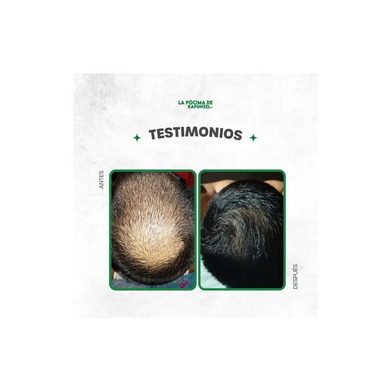Kit Shampoo Fortificante Anticaída +acondicionador De Regalo