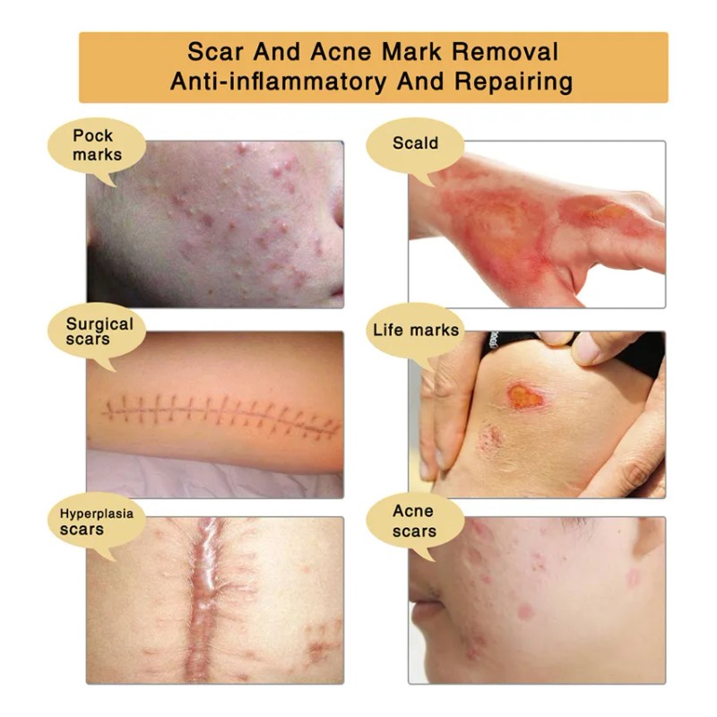 Gel Reparador Aliver Cicatrices Acné Queloides Mixta 30 mL Día