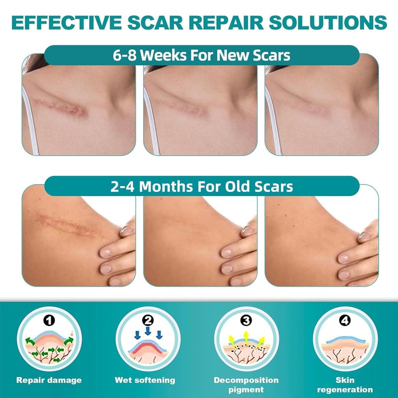 Extra Long Silicone Scar Sheets (1.6” x 200” Roll-5M), Silicone