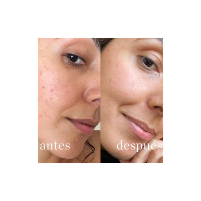 Sérum facial antiacné y antimanchas para piel grasa con acido