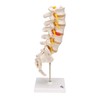 3B Scientific A76/5 Lumbar Spinal Column with Dorso-Lateral Prolapsed Intervertebral