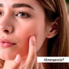 Simple Pimple - Pickelpflaster, Pimple Patches mit Salicylsäure, Teebaumöl, Akne,