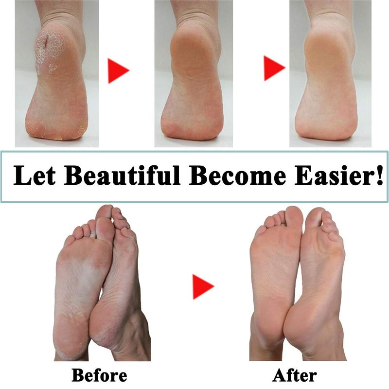 Pack of 14 Extra Coarse Mineral Replacement Rollers Compatible with