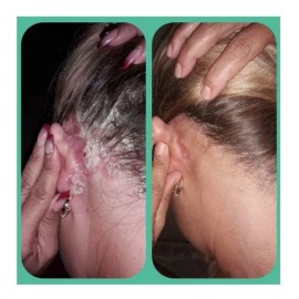 Kit Shampoo Psoriasis Y Caspa Alquitran Hulla 2lt Envío Grat