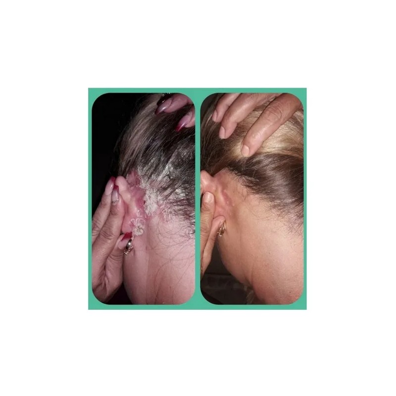 Kit Shampoo Psoriasis Y Caspa Alquitran Hulla 2lt Envío Grat