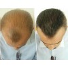 2 Volosy Original Fibras Capilares Disimular Calvicie 28g