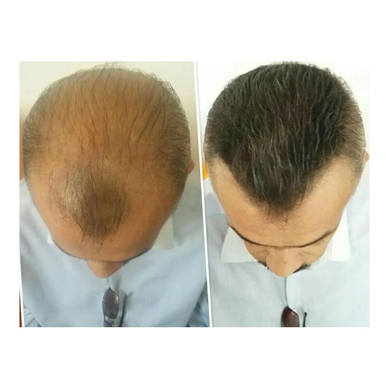 2 Volosy Original Fibras Capilares Disimular Calvicie 28g