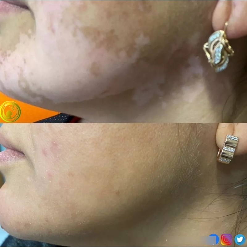 Cenit Crema Alba, Para Piel Con Vitíligo