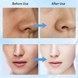 Dark Spot Remover for Face and Body,Dark Spot Remover Serum,Dark Spot Corrector,Sun S/pot and Age S/pot Remover,Freckle Removel Cream,Hydrating Serum,Brightening Serum,Skin Serum,Facial Serum