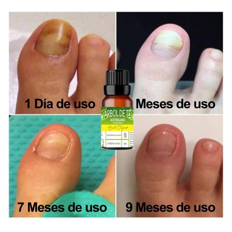 Aceite Esencial De Árbol De Té Antimicotico 100 % Natural