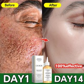 ouhoe Salicylic acid anti-acne essence is used to shrink pores, target rough skin, repair face, shrink pores, eliminate acne marks, blackheads and blackheads - Specification: 1 pcs