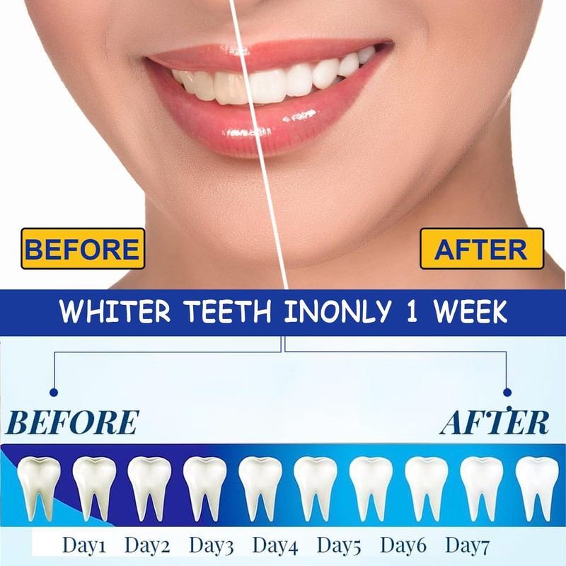 SSKHE Pack of 28 Teeth Whitening Bands, 9D Teeth Whitening