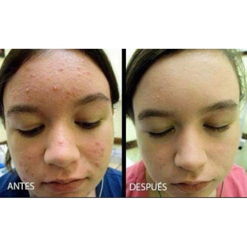 Sheló Nabel Mascarillas Faciales Piel Grasa, Anti Acné, Limpieza Prfunda
