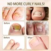 Ingrown Toenails Set, Nail Clip, Toenails, Pack of 180
