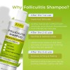 Shampoo Antifúngico Cuero Cabelludo Sensible 200 Ml