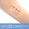 Emergency Wound Closure Devices, Zipper Wound Closure Strips, Laceration Closure