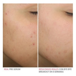 It Cosmetics Bye Bye Breakout Suero Ácido Salicílico 30ml Todo Tipo De Piel Día/noche