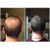 FIT FORLIFE DHT BLOCKER Promotes Fast Hair Growth Pills Supplement