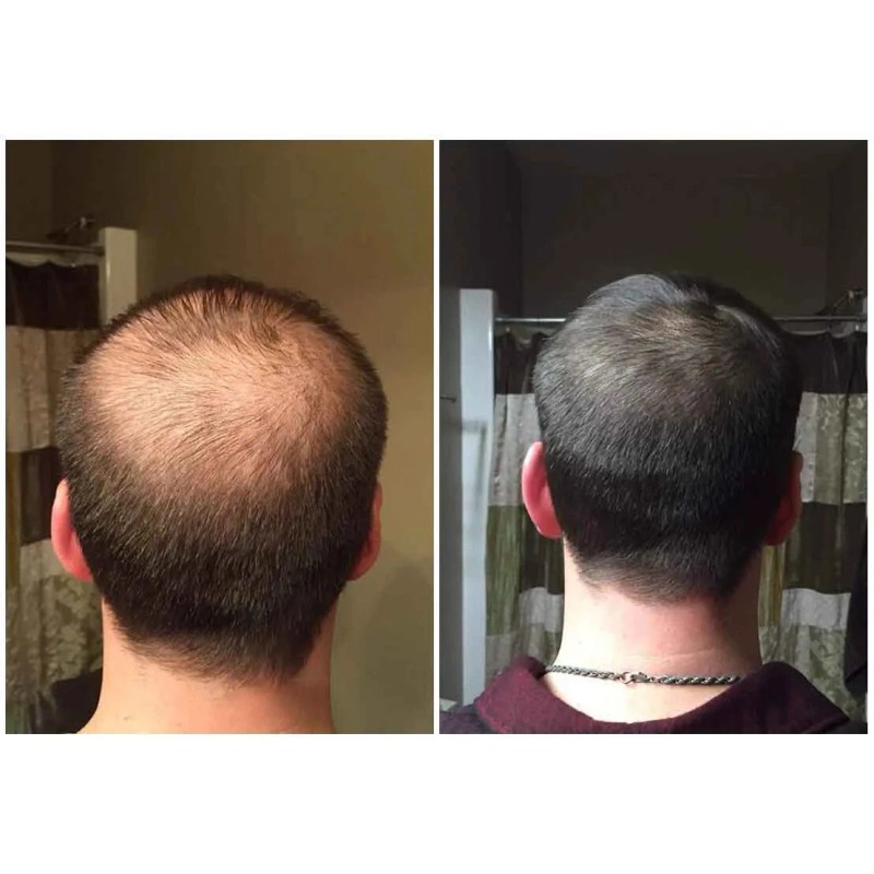 FIT FORLIFE DHT BLOCKER Promotes Fast Hair Growth Pills Supplement