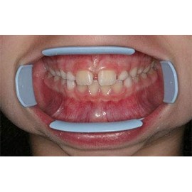 PRM Comfortview Lip and Cheek Retractor Small Pk/2